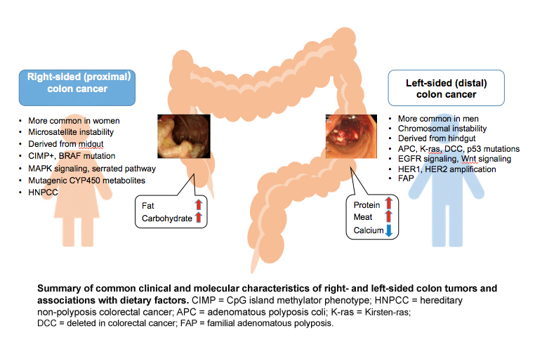 Cuál es el cáncer de colon más agresivo